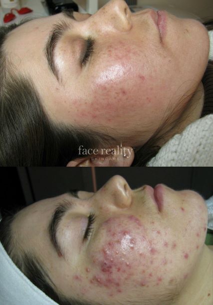 Acne Consultation in person + First Treatment