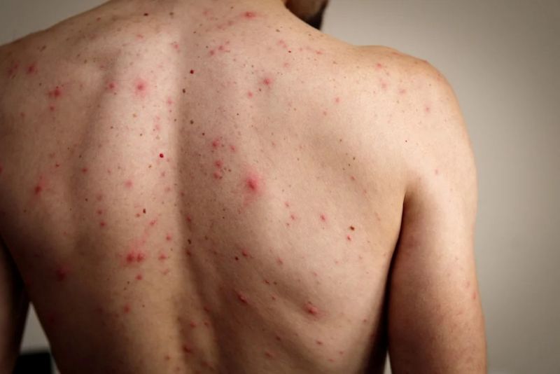 Balance Body Acne with Ayurvedic Solutions