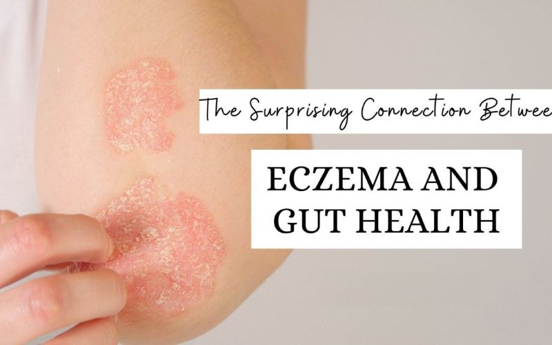 Eczema and Gut Health
