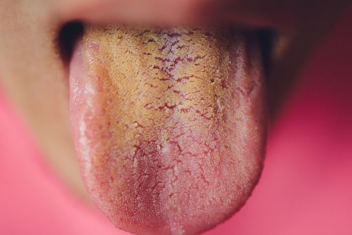 Yellow Tongue
