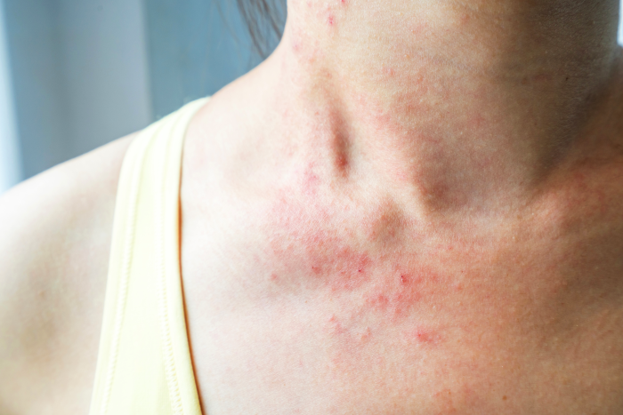 Ayurveda for Itchy Skin: Hives Relief