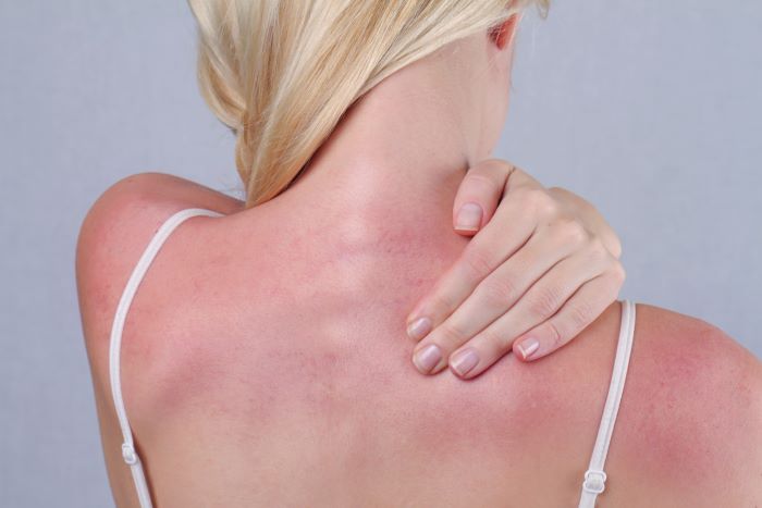 Heal Sun Damage with Ayurveda