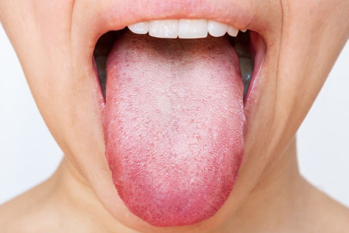 White Tongue