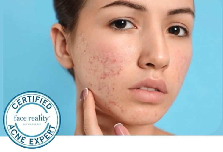 Acne Clinic in Mission Hills, San Diego